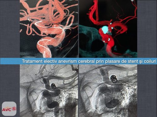 SCJU „Pius Brînzeu” Timișoara formează noi specialiști în neuroradiologie intervențională pentru tratarea AVC